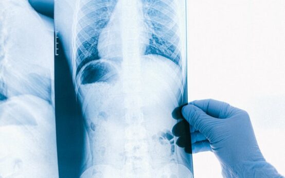 A radiologist examining a brain scan with an AI overlay highlighting potential anomalies on a high-tech tablet.